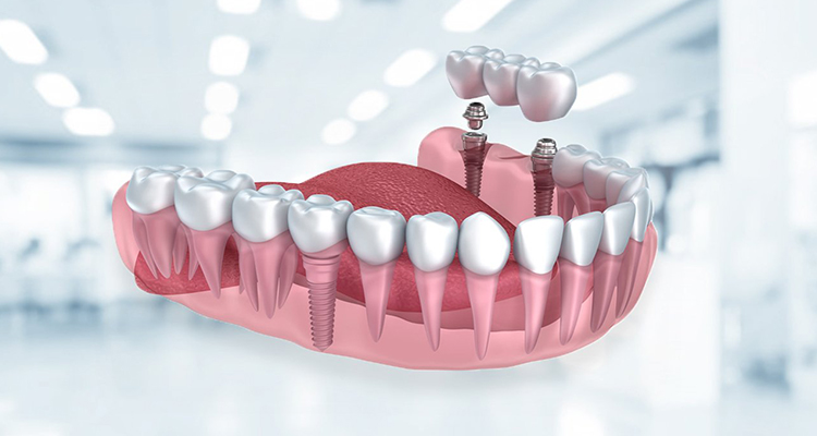 Fixed Full Mouth Implant