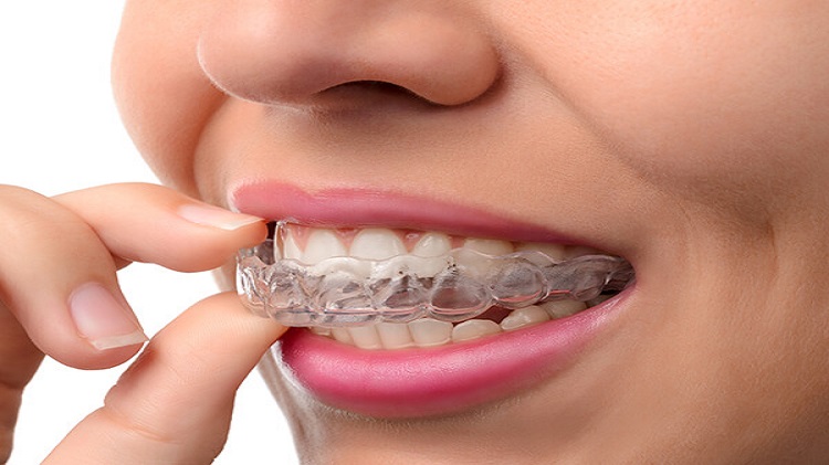 Invisalign Providers & Braces