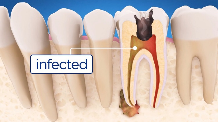 Painless Root Canal Treatment